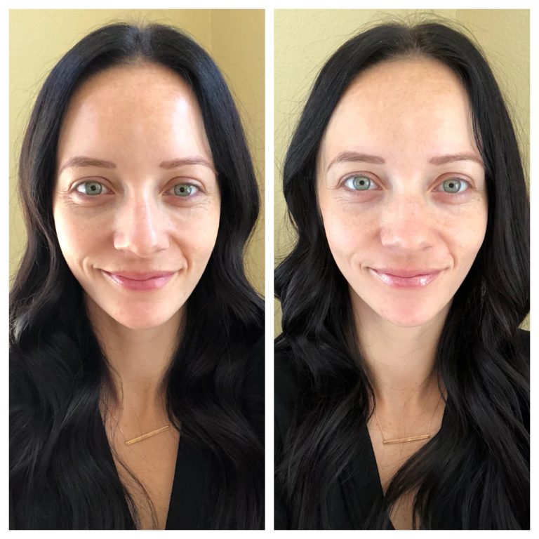 Glyton Chemical Peel Before and After | Beauty | Outfits & Outings