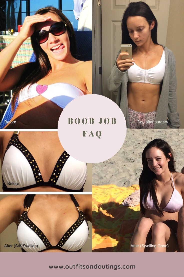 Boob Job FAQ: Everything you Should Know About Breast Enhancement featured by top US life and style blogger, Lauren of Outfits & Outings