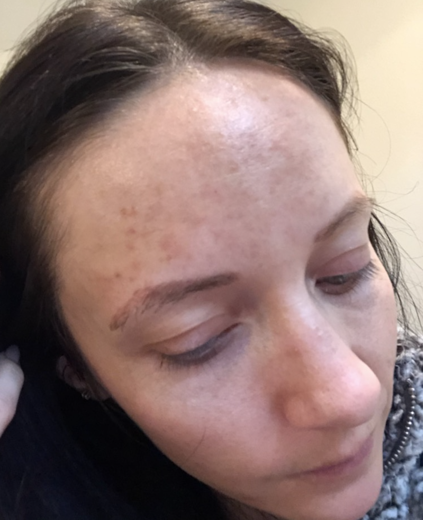 Allergic Reaction To Makeup S - Mugeek Vidalondon Makeup Allergic Reaction