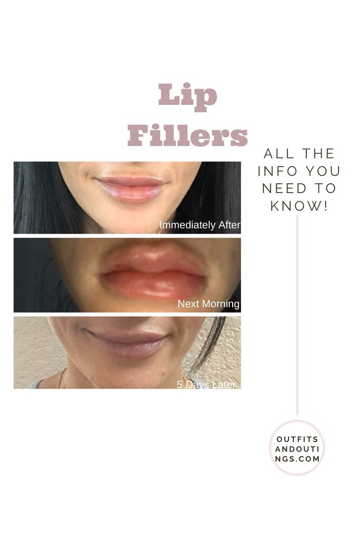 Lip Fillers 101 + Before and After Pictures featured by top US beauty blog, Outfits & Outings