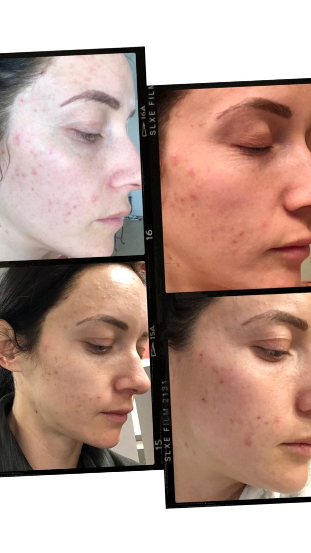 Acne and Anti Aging Skincare Routine by popular Las Vegas beauty blog, Outfits and Outings: collage image of a woman with acne. 